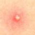 Pimple Coin logo