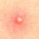 Pimple Coin logo